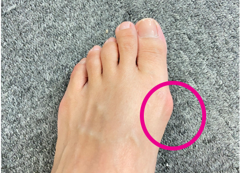 糖尿病足