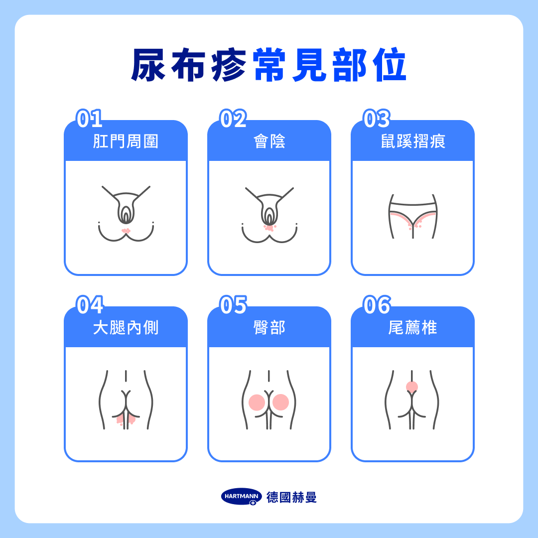 尿布疹分級