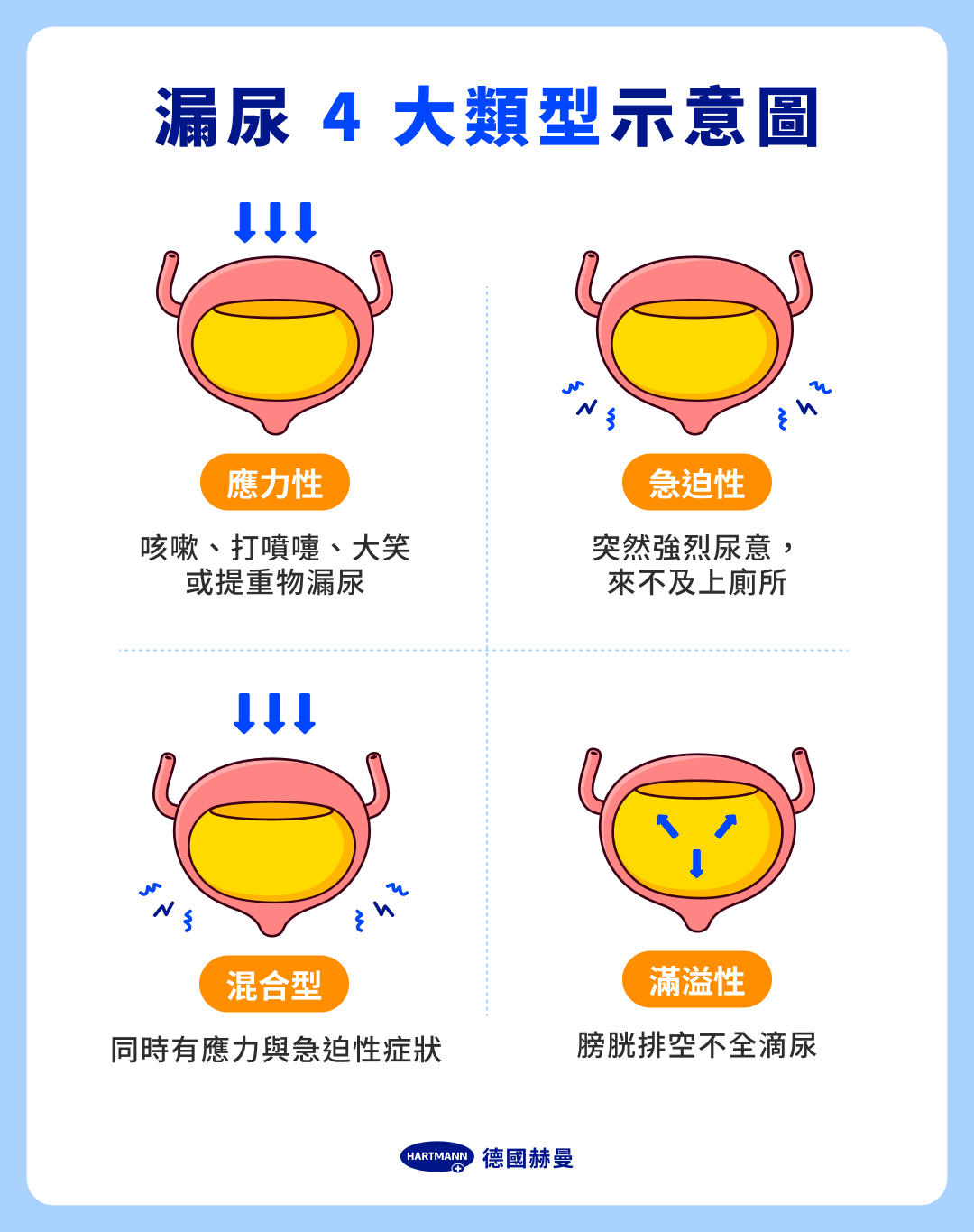 漏尿 4 大類型示意圖